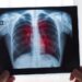 Cântăreț celebru, diagnosticat cu cancer la plămâni