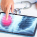 Un nou medicament împotriva cancerului pulmonar, autorizat.A ajutat la micșorarea sau reducerea tumorii la 79% dintre pacienții care nu primiseră anterior niciun tratament cu TKI