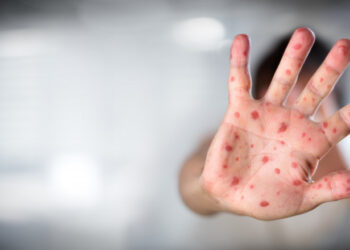 Ministerul Sănătății a declarat epidemie de rujeolă în România2.000 de cazuri la nivel național, în 29 de județe