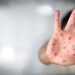 Ministerul Sănătății a declarat epidemie de rujeolă în România2.000 de cazuri la nivel național, în 29 de județe