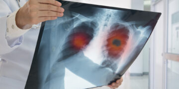 Bihorul printre cele 16 județe unde nivelul de radon depășește concentrația admisă. E gazul vinovat de creșterea numărului de cazuri de cancer pulmonar