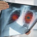 Bihorul printre cele 16 județe unde nivelul de radon depășește concentrația admisă. E gazul vinovat de creșterea numărului de cazuri de cancer pulmonar